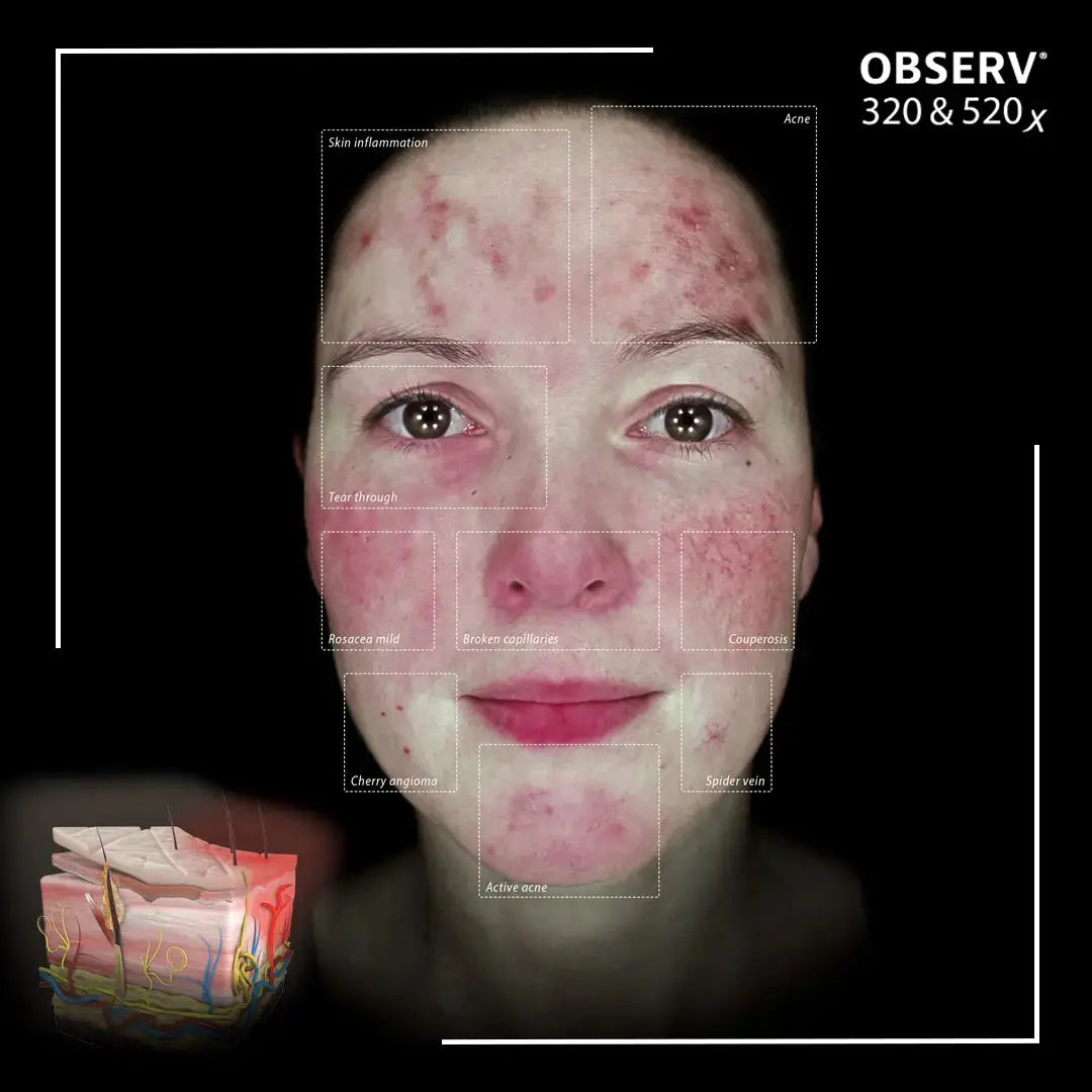 The Best Skincare Routine for Rosacea in the UK — A Clinician’s Guide - Stratum Clinic