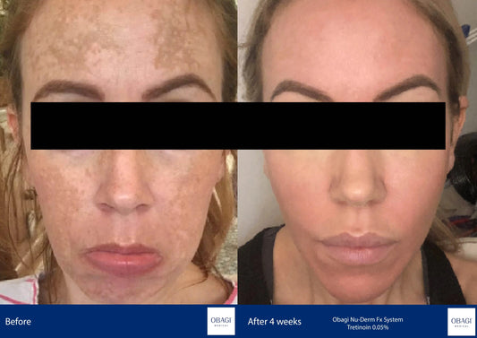 How to Get Rid of Pigmentation — A Clinician's Guide to Even Skin Tone - Stratum Clinic