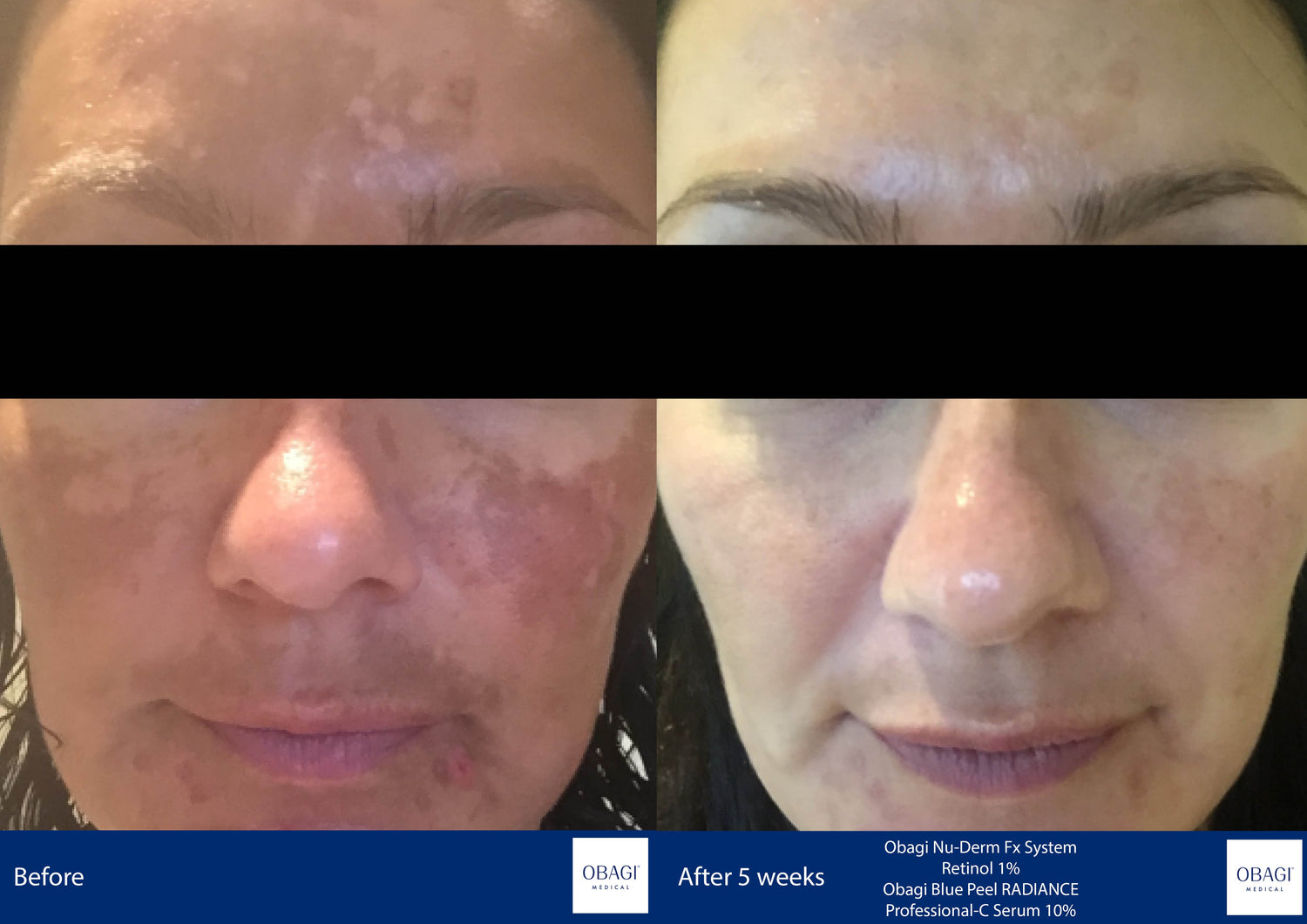Pigmentation & Uneven Tone