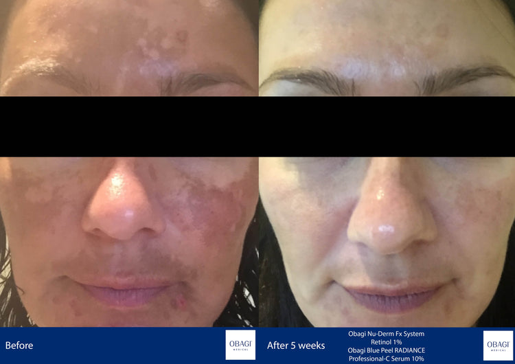 Pigmentation & Uneven Tone