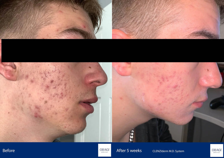 clenziderm 5 week results - stratumclinic.co.uk