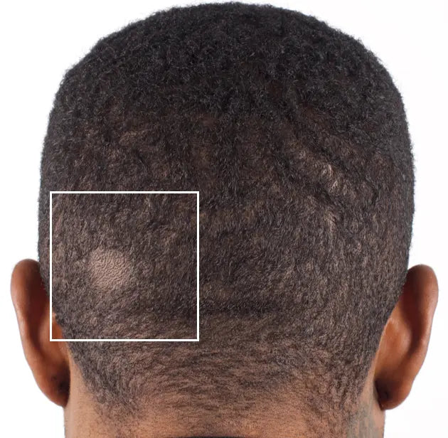 Nu-Cil BioStim Scalp Serum before and after — Male back of head baseline