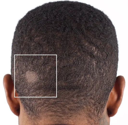 Nu-Cil BioStim Scalp Serum before and after — Male back of head baseline