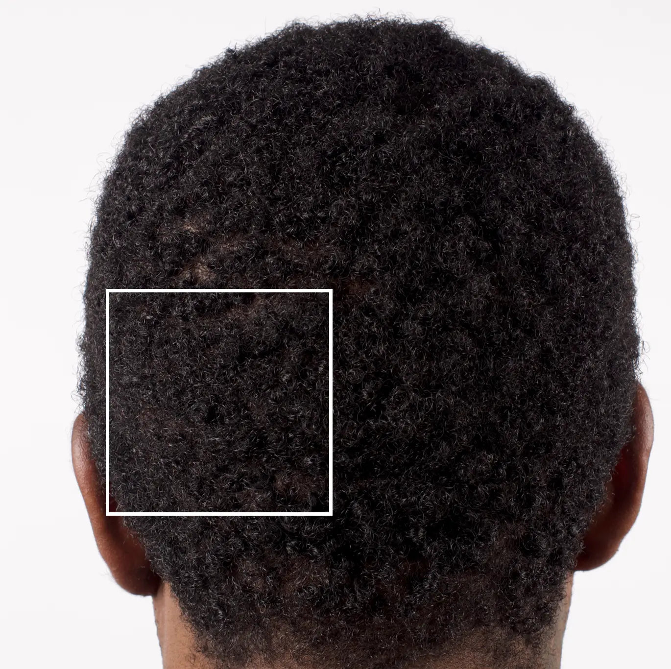 Nu-Cil BioStim Scalp Serum before and after — Male back of head Week 12 results