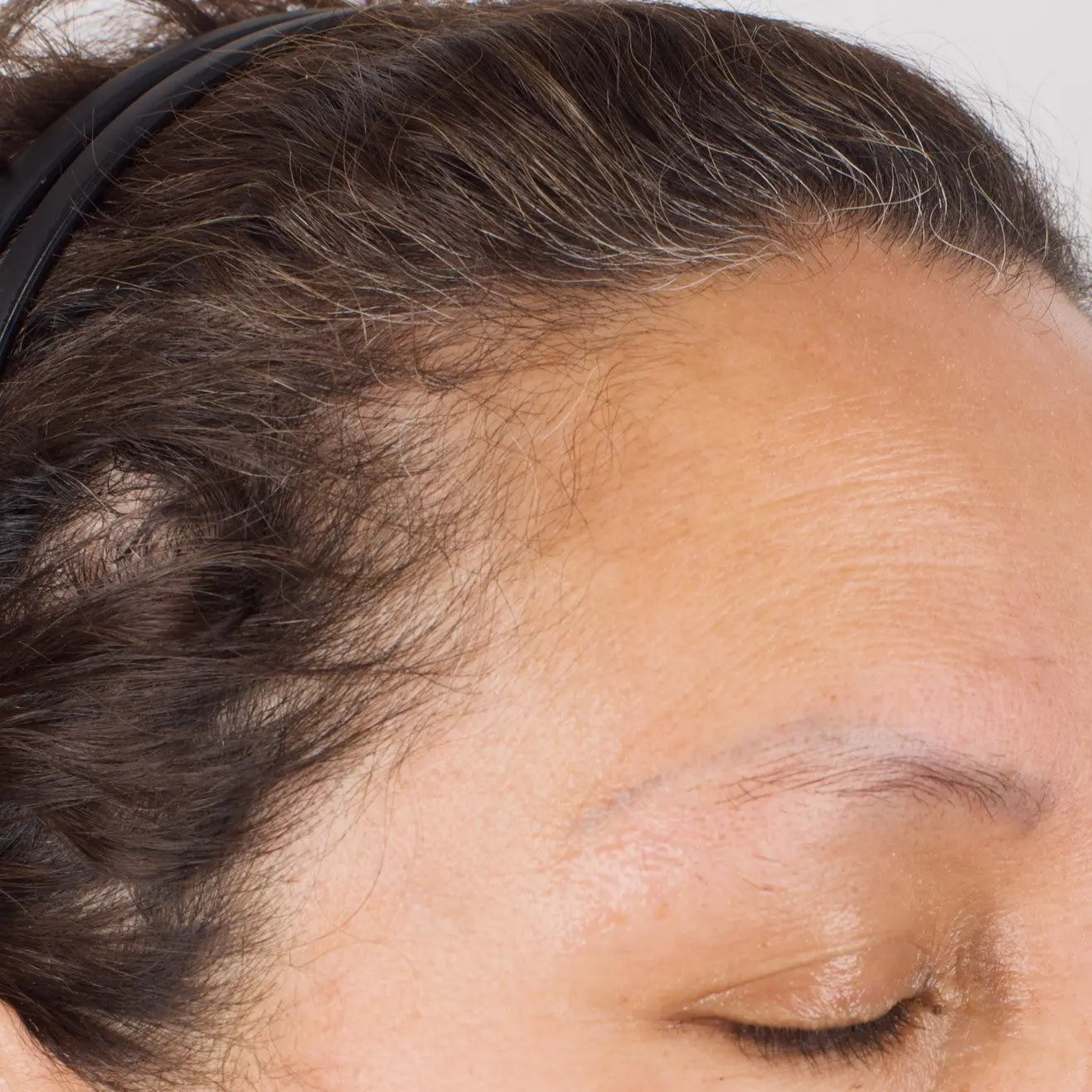 Nu-Cil BioStim Scalp Serum before and after — Female temporal hairline baseline