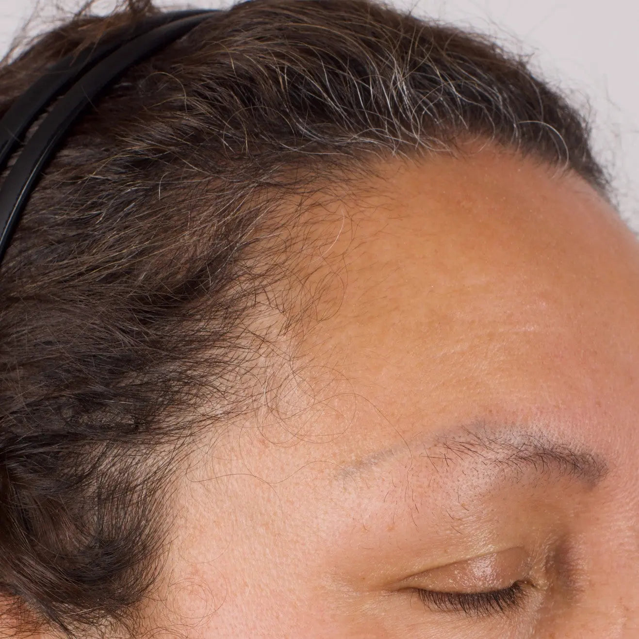 Nu-Cil BioStim Scalp Serum before and after — Female temporal hairline Week 2 results