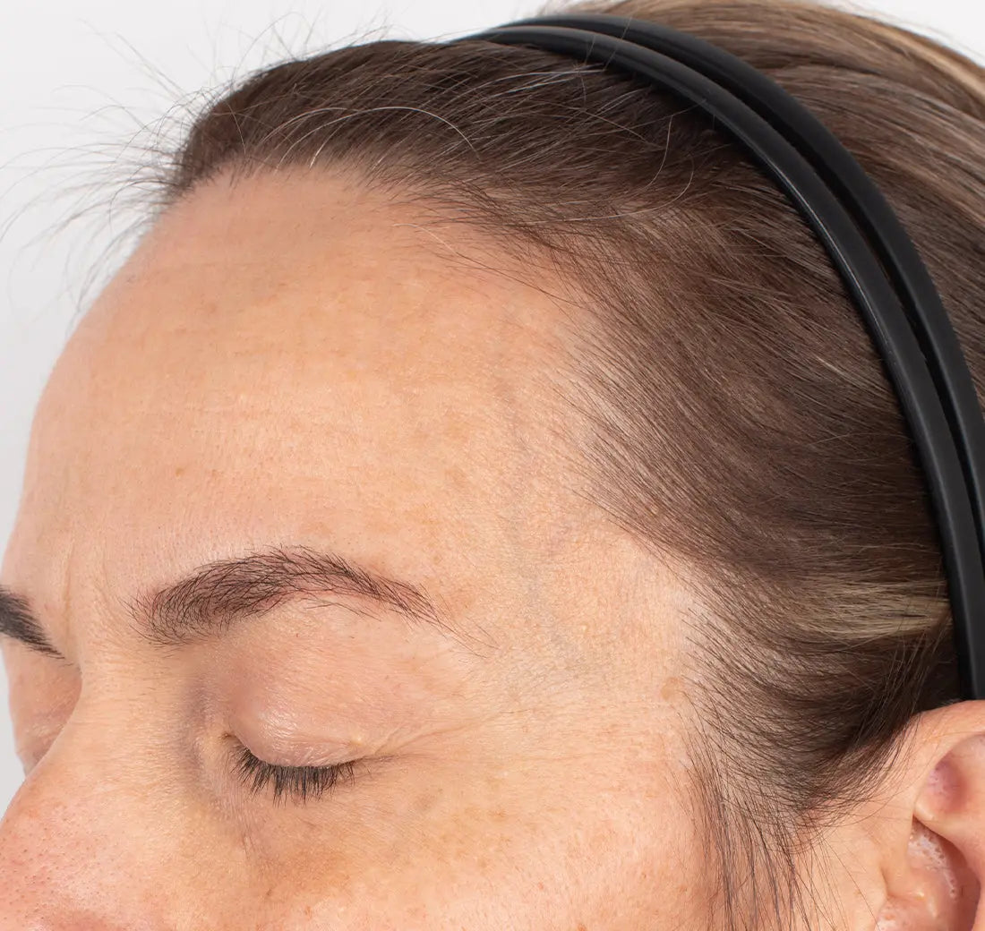 Nu-Cil BioStim Scalp Serum clinical before and after — Subject S61 baseline