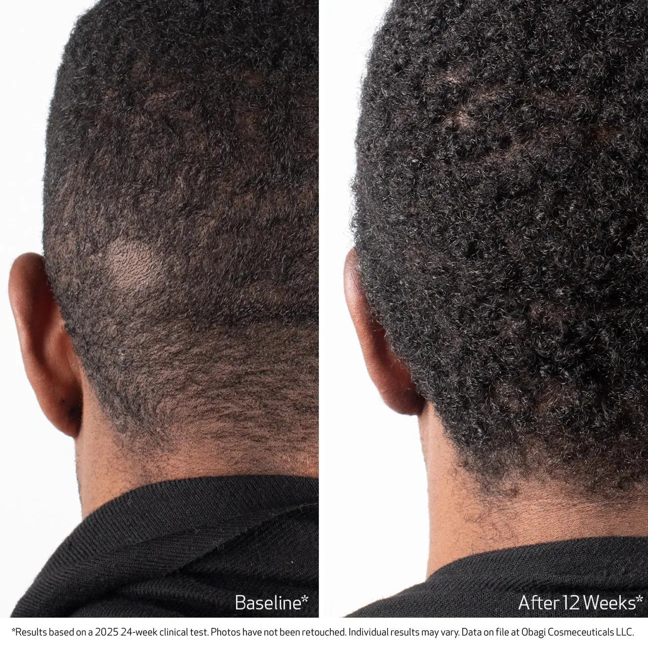 Nu-Cil BioStim Scalp Serum before and after — result 2
